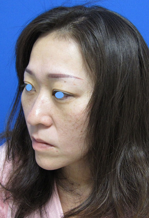 目の下のたるみ、目のくまでお悩みの方、切らずに完璧に解決します。TCB-R法　手術直後　症例写真